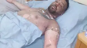 تعرض شاب سوري في الخيام لحروق عديدة في جسمه ووجهه