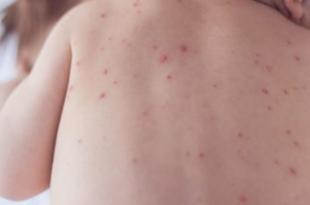 أبرز الأمراض الجلدية شيوعاً في الصيف؟